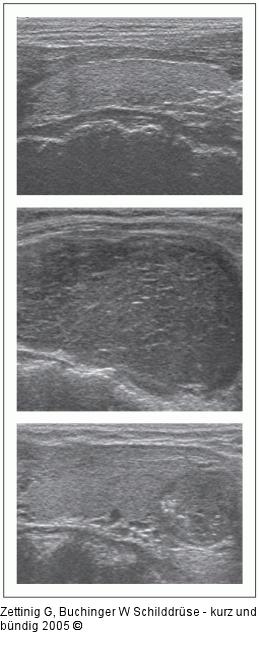Gestörte Schilddrüsenmorphologie