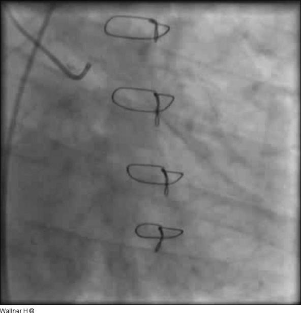 Linkes Kranzgefäß (LAO 30°/20°)