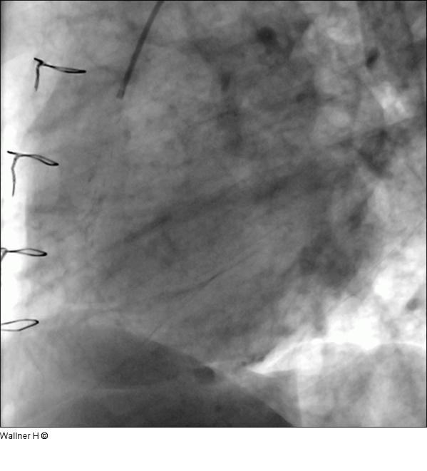 Saphena Vena Graft auf die rechte Kranzarterie (RAO 60°/0°)