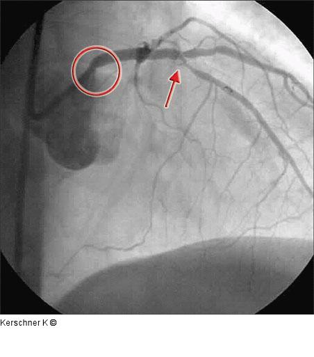 Linke Koronararterie RAO/Kranialprojektion
