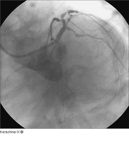 Linke Koronararterie LAO/Kaudalprojektion