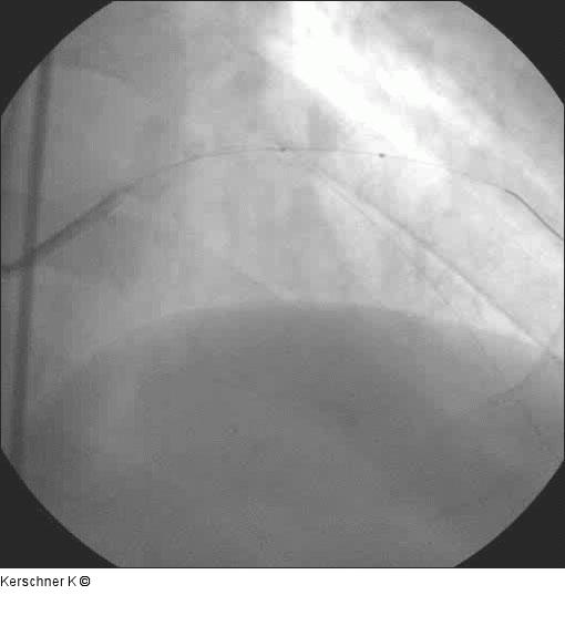 Sondierung - BMW-Führungsdraht