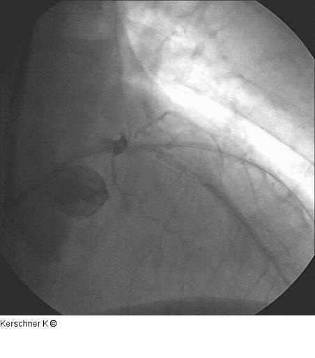 Vordilatation - Ergebnis