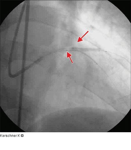 Stentimplantation - LAD