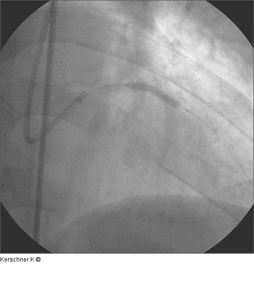 Stentimplantation - LAD