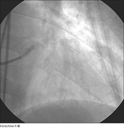 Primäre Stentimplantation - Ostiumhauptstamm
