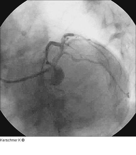Endergebnis LAO/kaudal