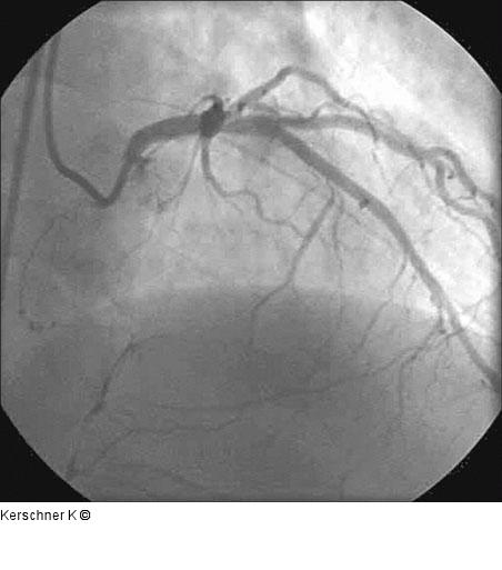 Kontrollangiographie