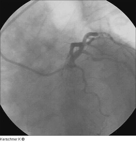 Kontrollangiographie