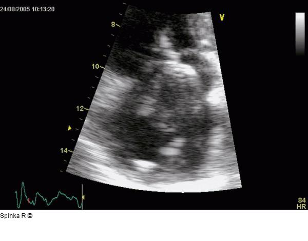 Rechtsatriale Thrombose nach 2-Kammer-Schrittmacherimplantation