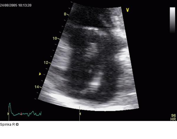 Rechtsatriale Thrombose nach 2-Kammer-Schrittmacherimplantation