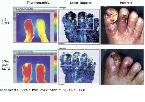 Chronisch kritische Beinischämie - SCTX