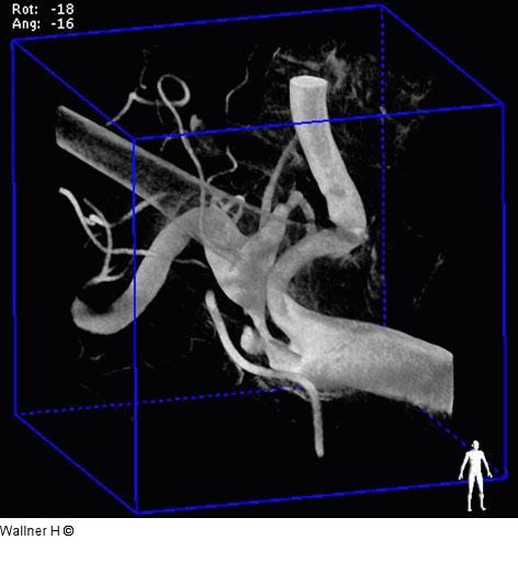 Stenose - Arbeitsprojektion