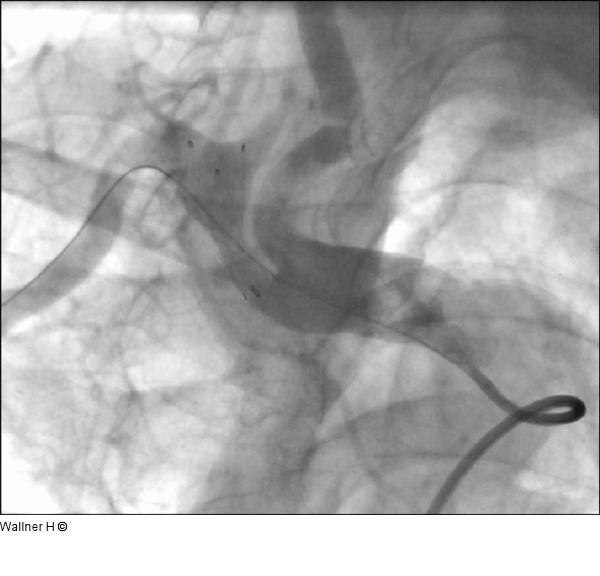 Abschlußangiographie