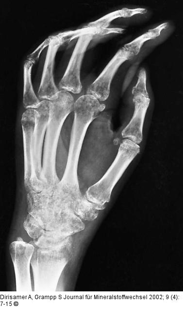 Osteoporose - Radiologie