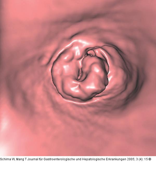 Colon descendens - Tumor