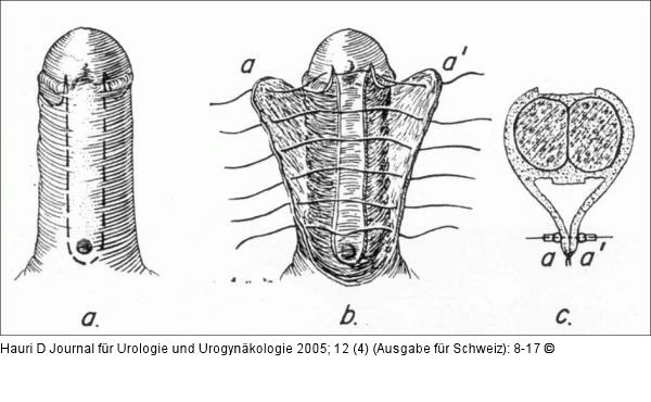 Hypospadiekorrektur - Browne