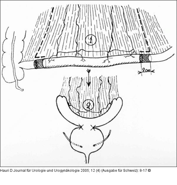 Blasenersatz - Ileum - Couvelaire