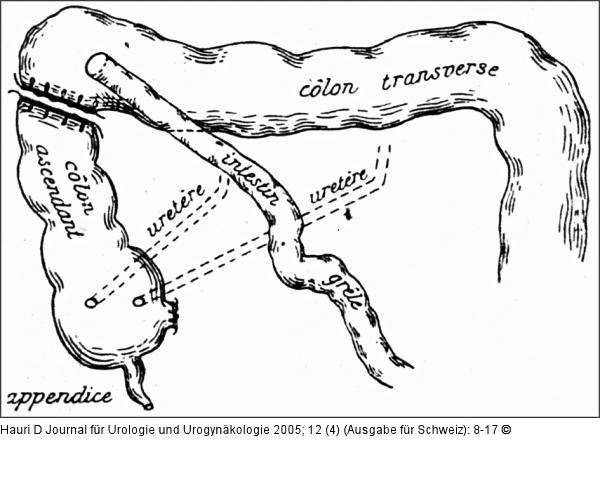 Ileocoecal-Reservoir - Verhoogen