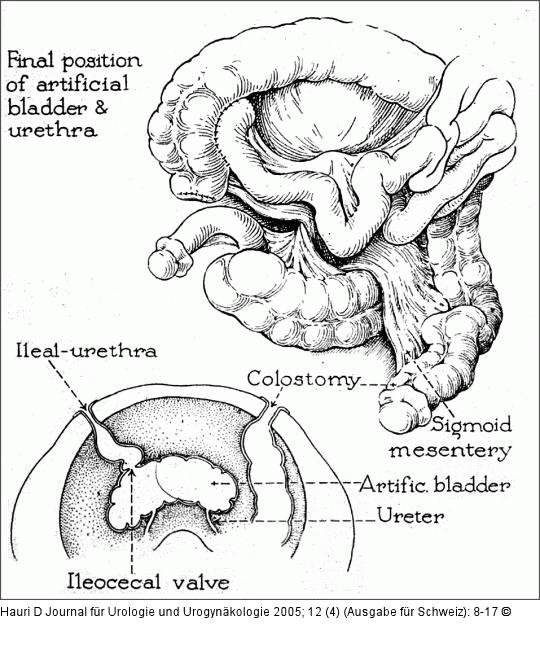 Ileocoecalblase - Ileocoecalklappe - Gilchrist