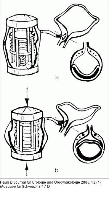 Blasenersatz - Kline