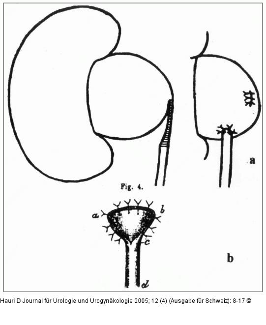 Ureterresektion - Küster
