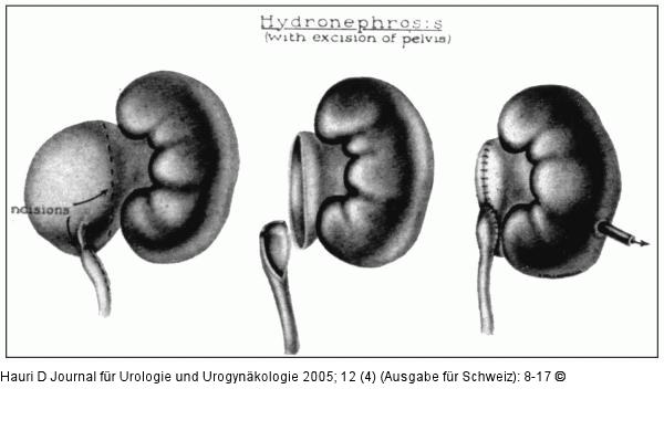 Elliptische Anastomose - Nesbit