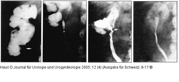 Erfolglose Ballondilatation - Nierenbeckenabgangsstenose