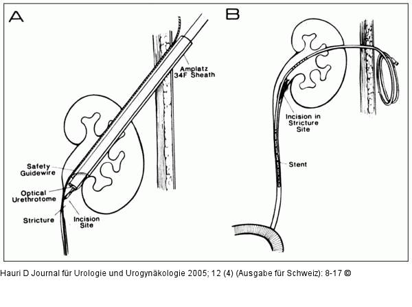 Perkutane anterograde Pyeloureterotomie