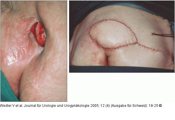 Axiale Lappenplastik