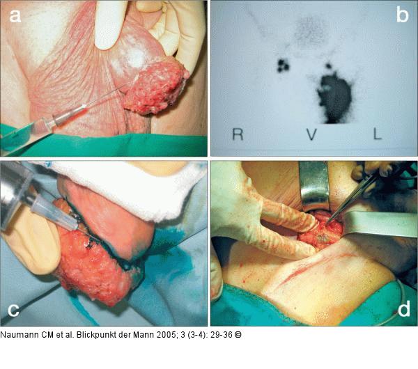 Dynamische Sentinel-Lymphknotenexstirpation