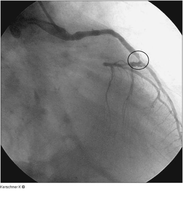 Aortokoronarer Venenbypass - RAO-Projektion