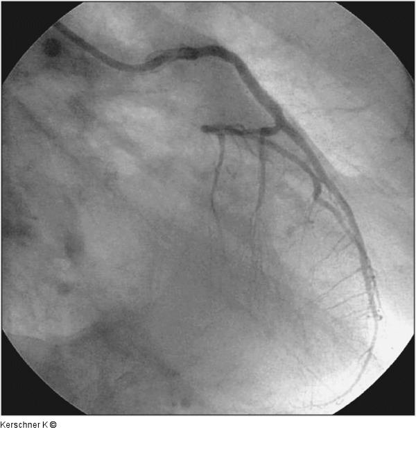 Kissing-Ballon - RAO-Projektion