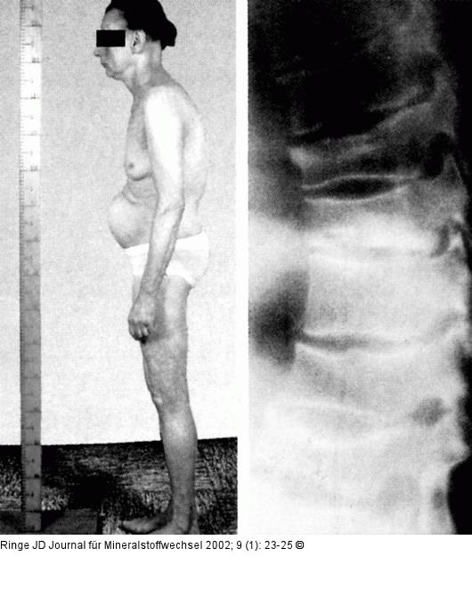 Osteoporose - Habitus
