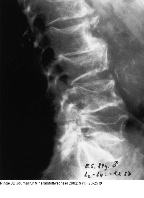 Osteoporose - Fraktur - Spondylose