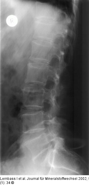 Osteoporose - Wirbelsäule