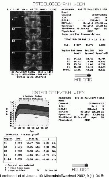 Osteoporose - Lendenwirbelsäule - DXA