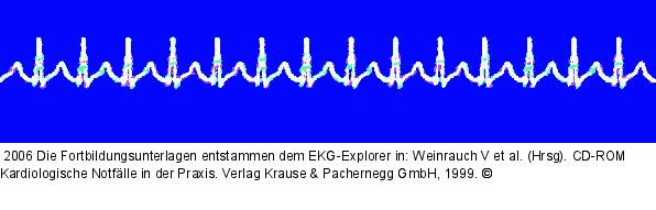 SVT (1)