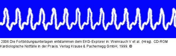 SVT (2)