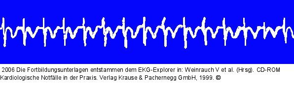 SVT (3)