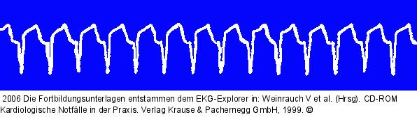 SVT (4)