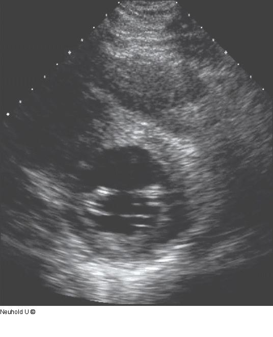 Mäßig reduzierte LVF