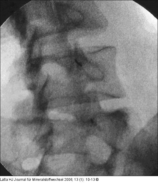 Facettengelenke - Intraartikuläre Infiltration