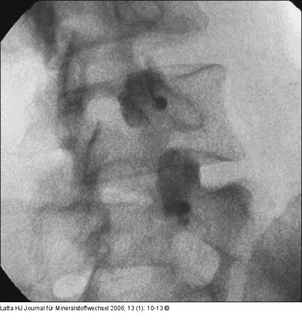 Intraartikuläre Infiltration - Facettengelenk