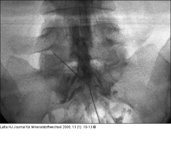 Hiatus sacralis - Epiduralkatheter