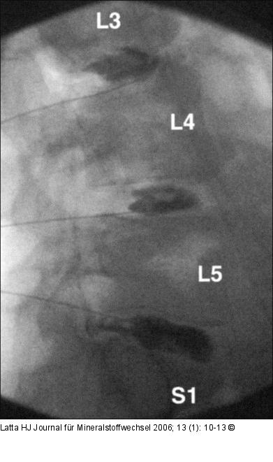 Lumbale Provokationsdiskographie