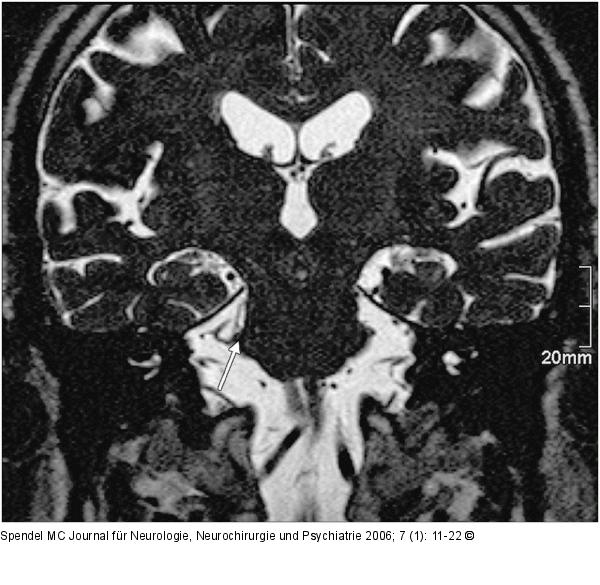 Nervus trigeminus - Arteria cerebelli superior