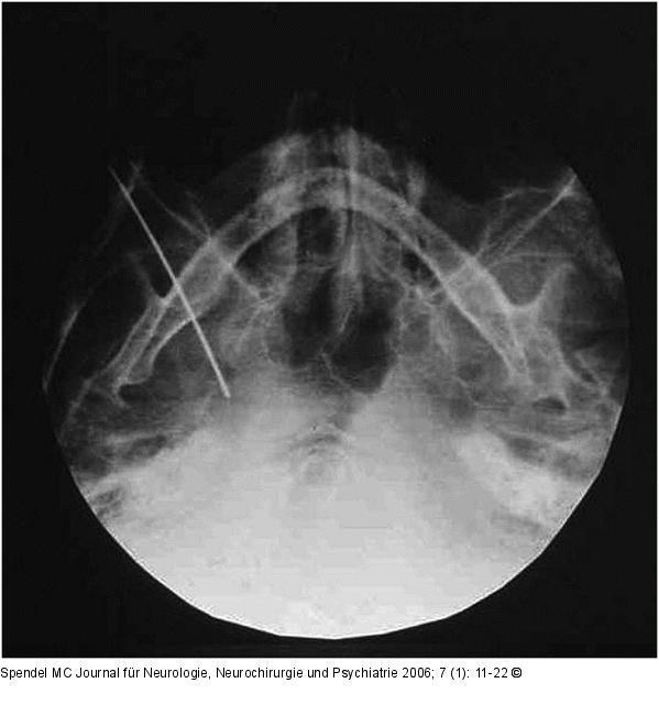 Elektrodenspitze - Foramen ovale