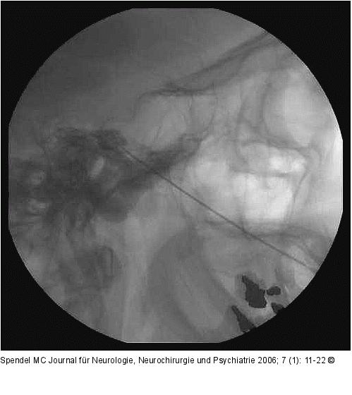 Glyzerinrhizolyse - Cavum Meckeli - Zisterna trigemini
