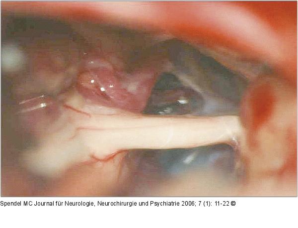 Kleinhirnbrückenwinkel - Nervus trigeminus - Arteria cerebelli superior